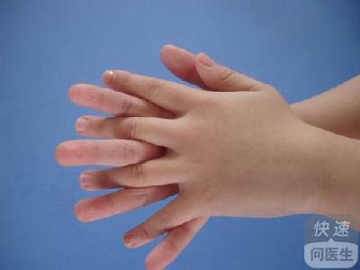 手指白癜风怎样治疗方法 了解方法及时治疗