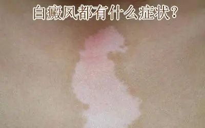 「焦点反馈」上海看白癜风病哪家医院好-白癜风会使皮肤出现哪些症状