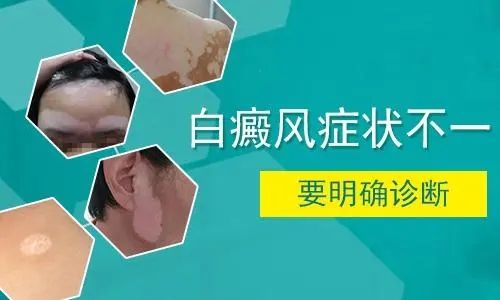 【总榜公开】上海白癜风医院排名-白癜风的症状特点是什么