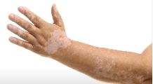 热点更新：上海哪个治疗白癜风好-手腕上出现白斑是白癜风的症状吗